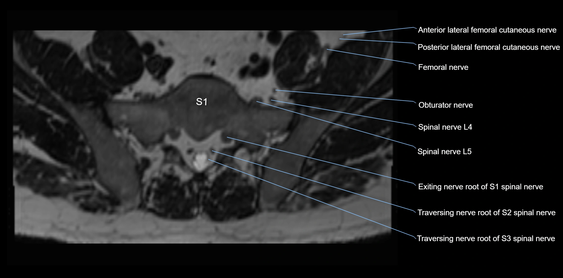 MR lumbosacral plexus axial cross sectional anatomy 3T  radiology  image-img-1008001-00072.webp